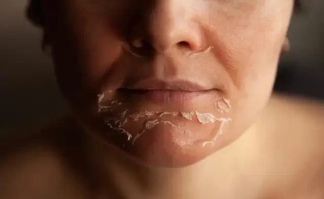 עור פנים יבש